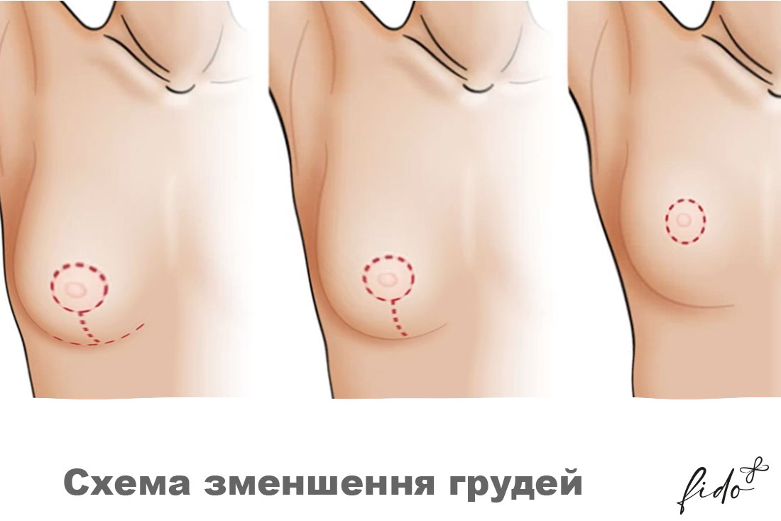 зменшення грудей Зменшення грудей: види та показання до операції fedoruk1985