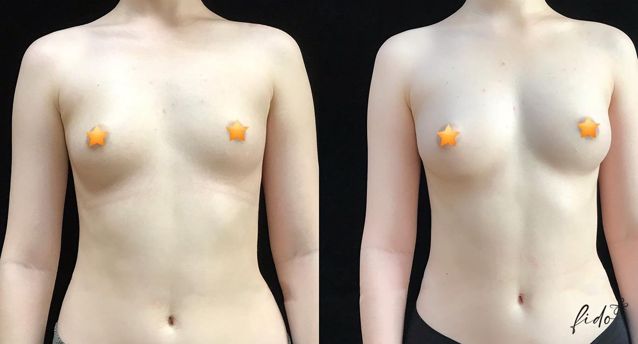 breast-lipofilling-1 Фото до и после: липофилинг груди