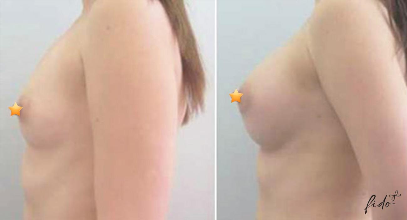 lipofiling_grudi_plastika-fedoruk-1 Ліпофілінг грудей Ліпофілінг грудей у Києві fedoruk1985
