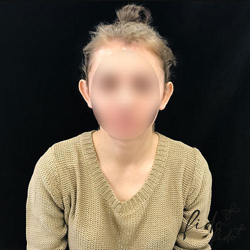 Otoplasty-5 Пример отопластики