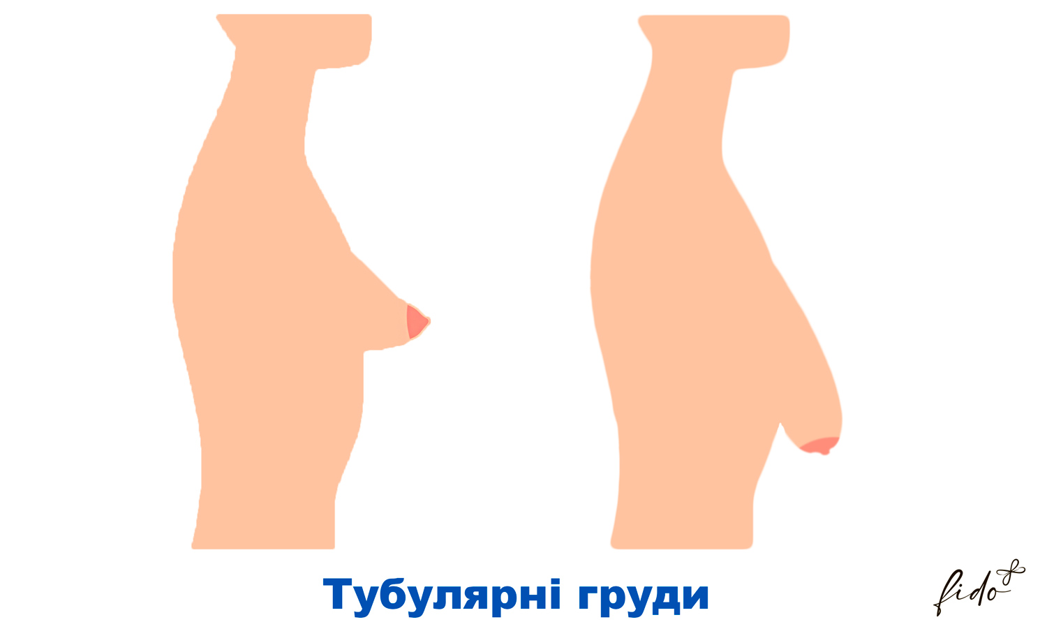 Що таке тубулярні груди, чому це відбувається, операція з виправлення 2 тубулярні груди