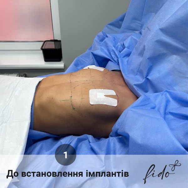 Збільшення грудей fido етапи (2) Збільшення грудей до та після мамопластики