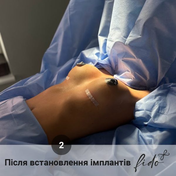 Збільшення грудей fido етапи (3) Збільшення грудей до та після мамопластики